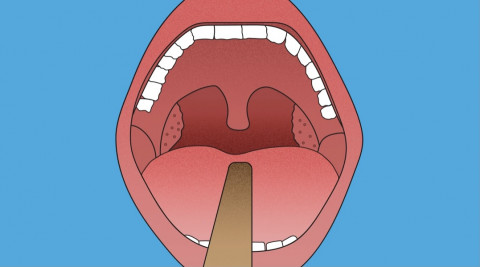 What is Tonsil (Tonsil)?
