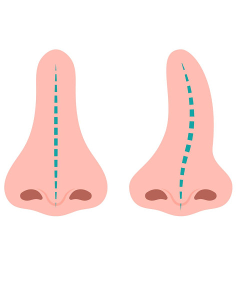 SEPTUM DEVİASYONU (BURUN EĞRİLİĞİ) AMELİYATI NEDİR?